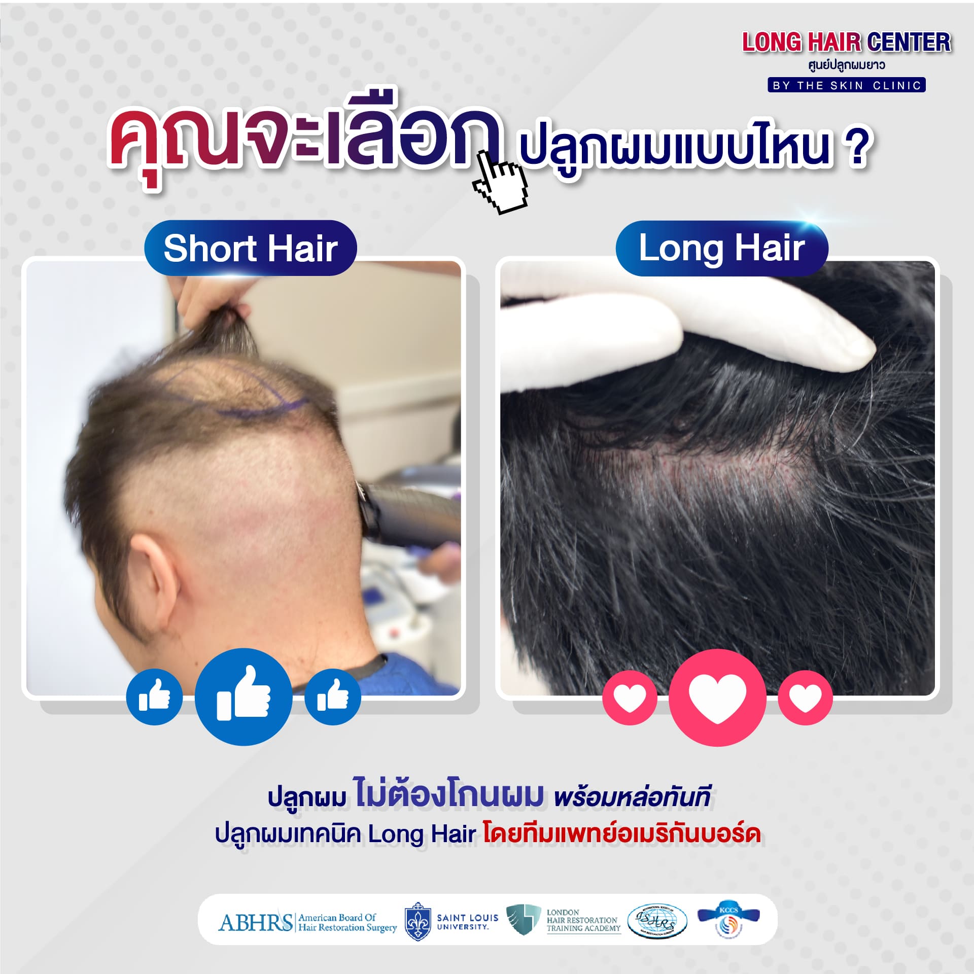 ปลูกผม Long Hair FUE ไม่ต้องโกนผม ไม่ต้องตัดผมสั้น