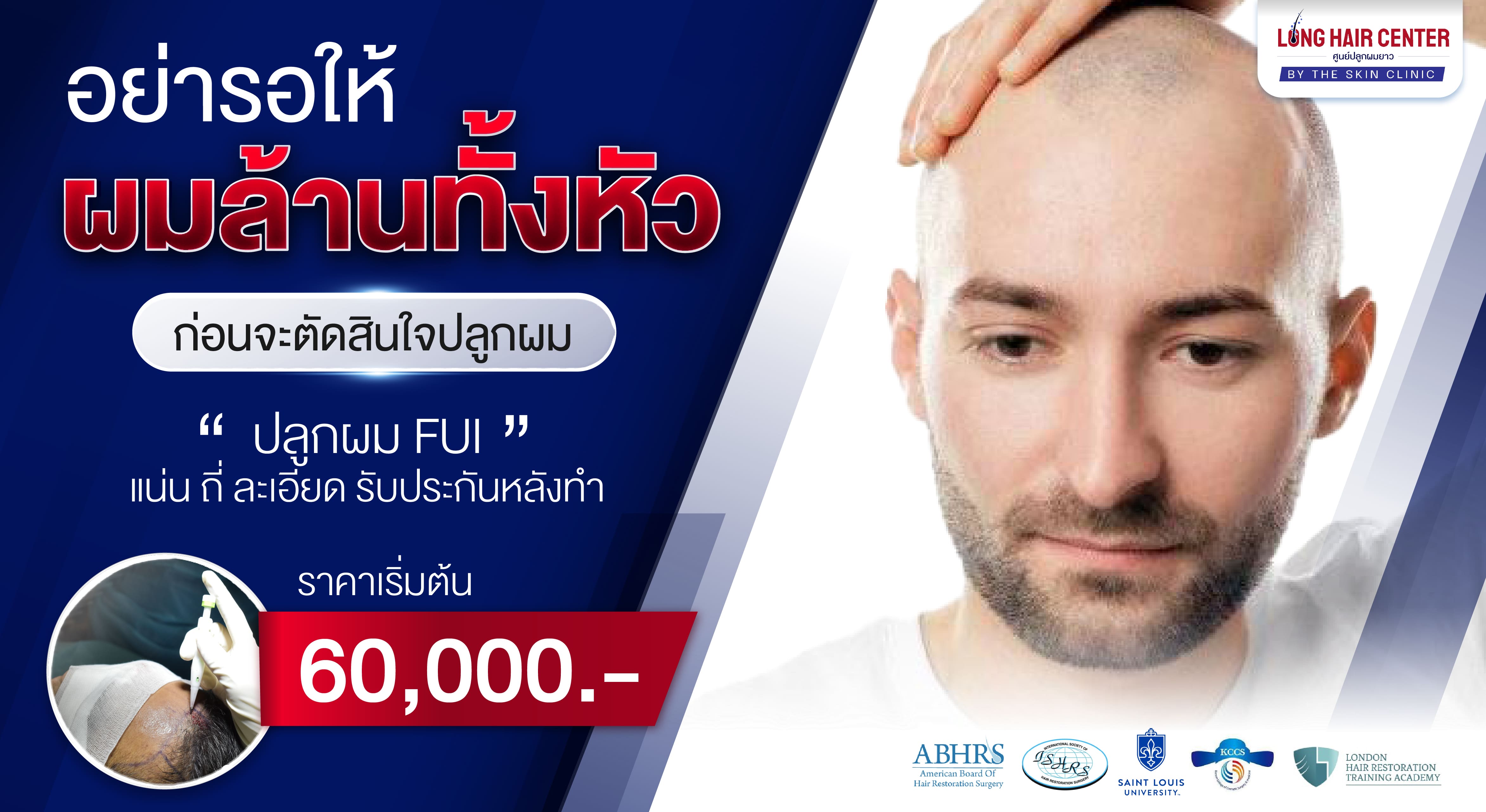  ปลูกผมไร้รอยแผลเย็บ FUE 500-1,000กราฟ เริ่มต้น 60,000 บาท