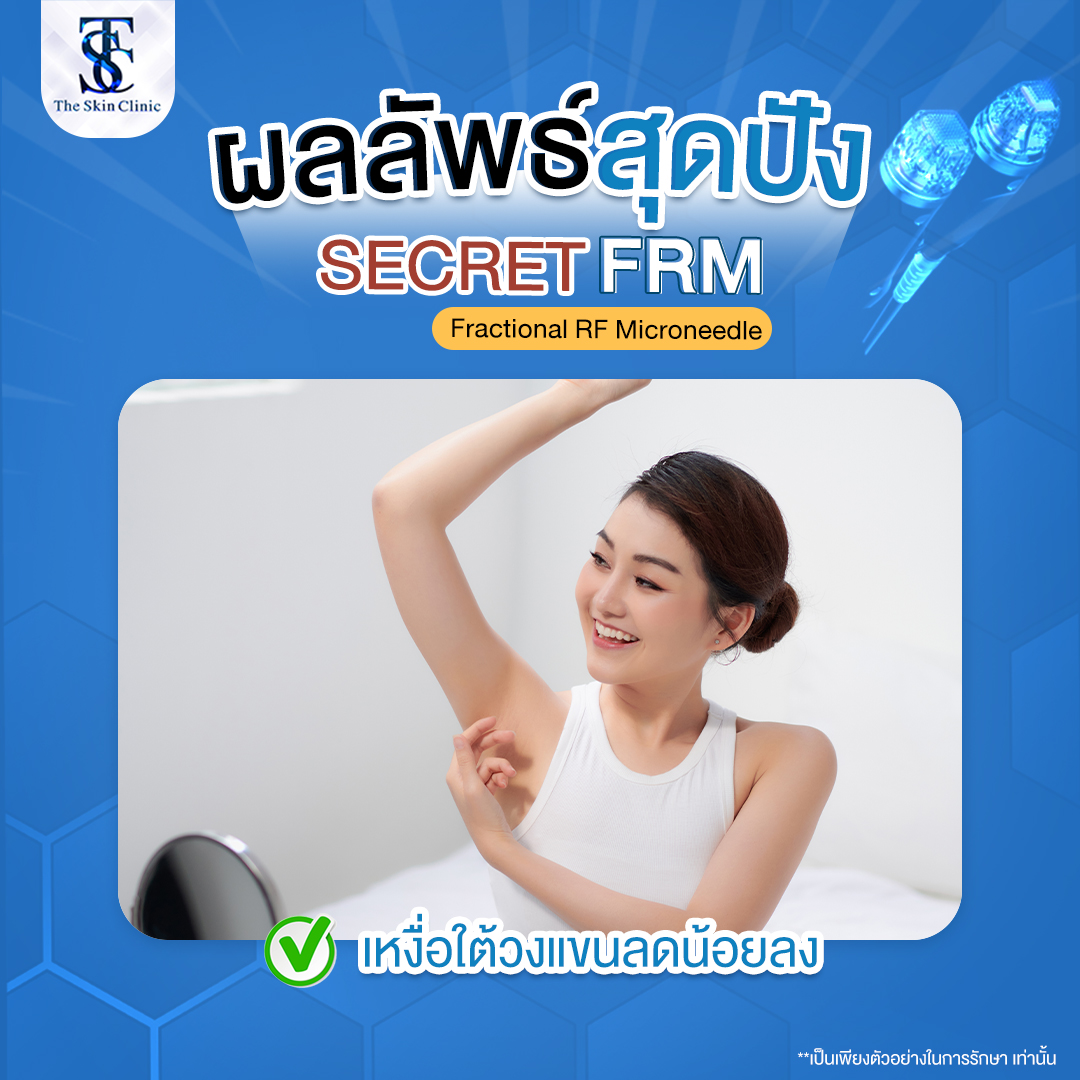 Secret FRM รักษากลิ่นตัวต่อมเหงื่อ 